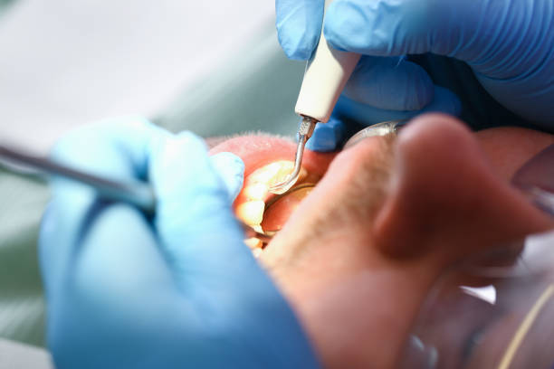 Best Emergency Treatment for Dental Infections or Abscesses in Rosend, LA