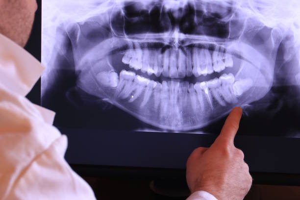 Best Emergency Wisdom Teeth Removal in Rosend, LA